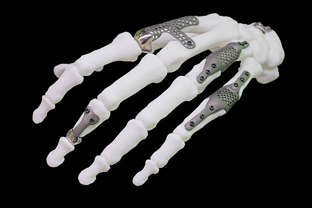 Hand 3D printing  titanium